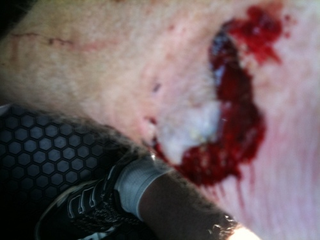 Illustration for article titled Blood Writes: This Knee Has A Mouth (WARNING: PUS)